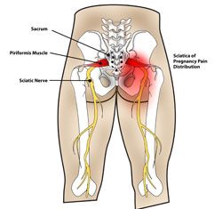 Sciatic Nerve Piriformis syndrome pregnancy back pain Dr. Lawrence Bagnell Chiropractor Newtown Langhorne PA